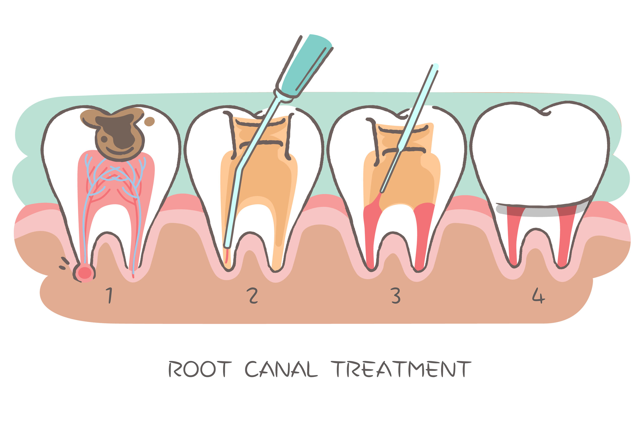 What You Need To Know About Getting a Root Canal