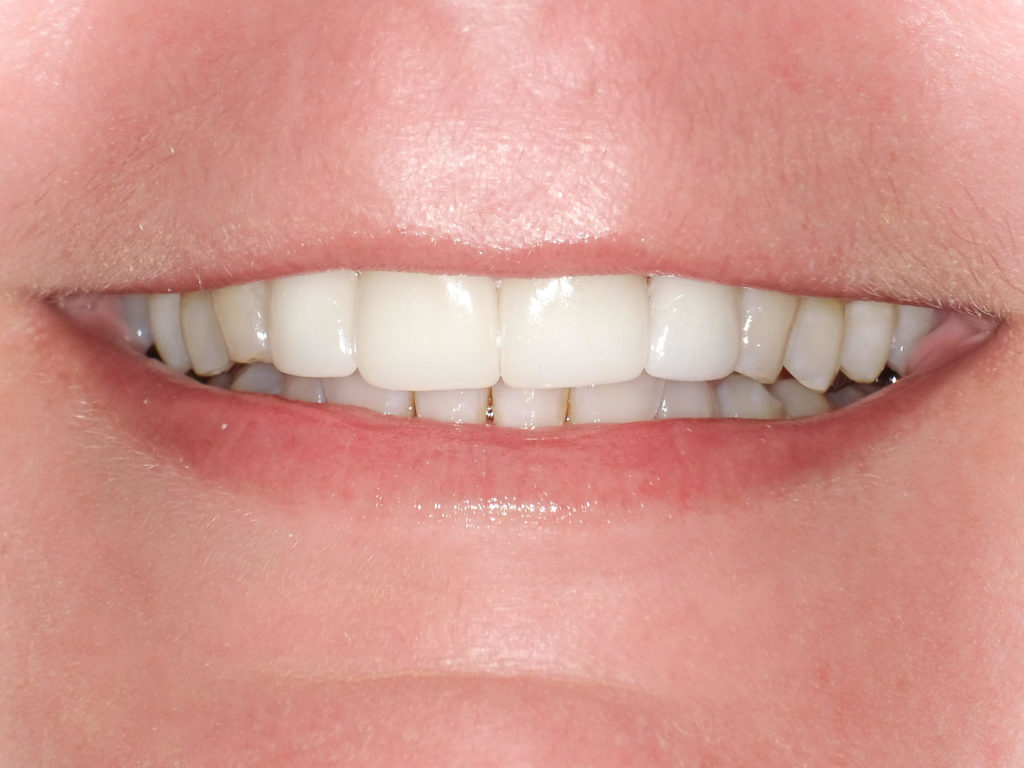 Ceramic Crowns on the upper four front teeth after