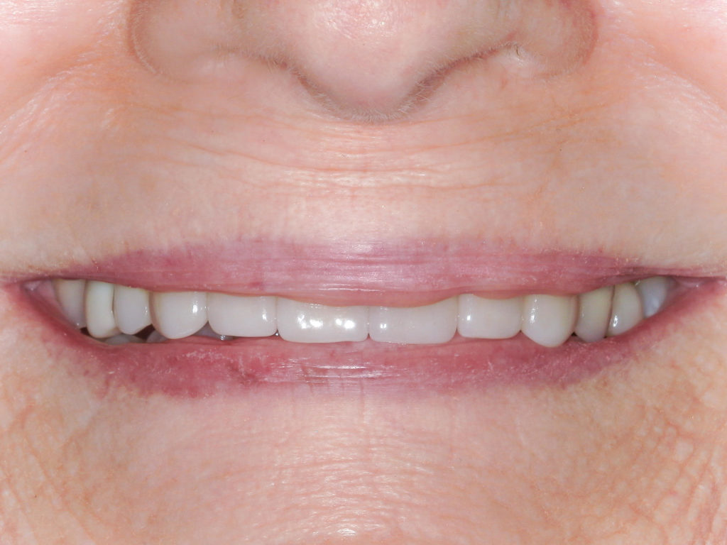 Smile makeover with full ceramic crowns on the upper front six teeth after