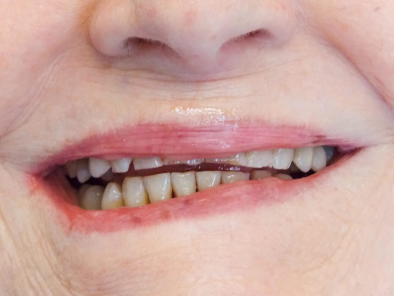 Smile makeover with full ceramic crowns on the upper front six teeth before